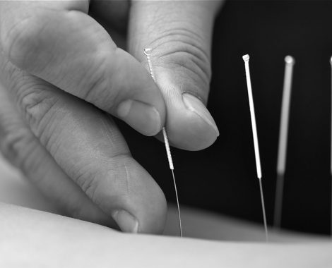 acupuncture-1